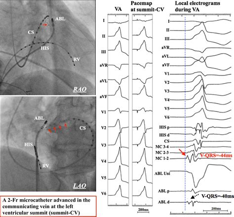 right ventricular summit arrhythmia map